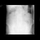 Pneumatosis of the colon: X-ray - Plain radiograph
